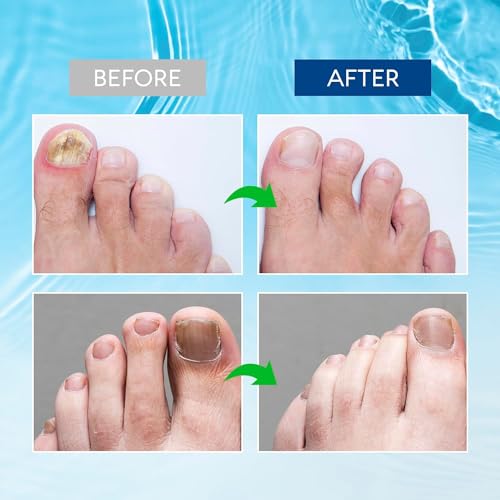 Toenail Fungus Treatment Extra Strength 30 ml Y2421